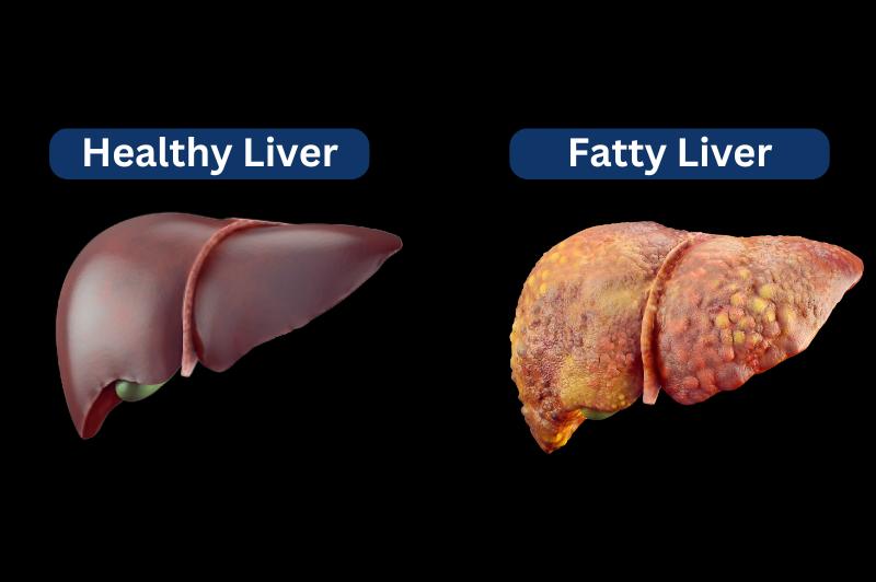 Kasus Hati Berlemak Meningkat di Seluruh Dunia, Penyakit Diam-Diam yang Kini Jadi Wabah Global