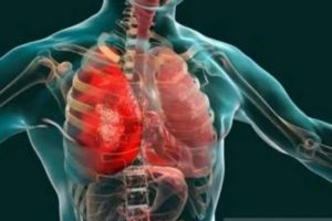 Dokter Ungkap 5 Kebiasaan Sederhana untuk Mengurangi Peradangan Kronis Tanpa Obat
