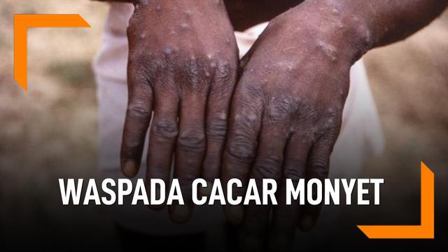  Riau Perkuat Pengawasan, Waspadai Penularan Monyekpox