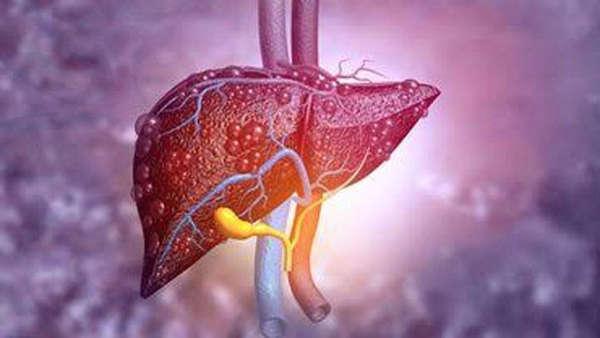  Hepatitis Akut Berjumlah 170 Kasus di Beberapa Negara