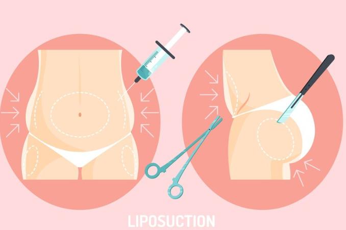  Begini Ternyata Tips Memilih Dokter Berkompeten untuk Lakukan Sedot Lemak