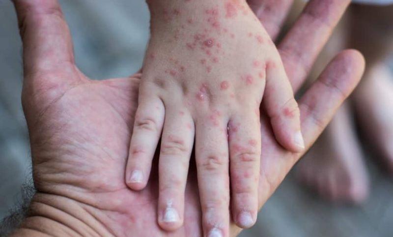  Tangsel Temukan Lima Kasus Suspek Mpox, Warga Diimbau Tak Panik