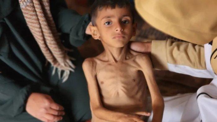  WHO Peringatkan Kematian Balita karena Kelaparan di Gaza Melonjak